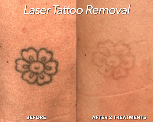 how to remove tattoo? laser removal of tattoo, scars and stretchmarks